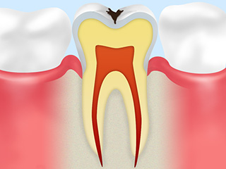 C1：エナメル質の虫歯　（見た目に変化が現れる段階）