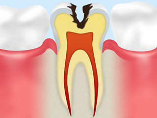 C2：象牙質の虫歯　（「しみる・痛む」の自覚症状が現れます）