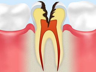 C3：神経に達した虫歯　（ズキズキと痛む段階）