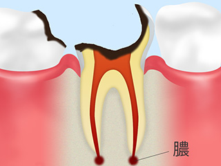 C4：末期の虫歯　（歯の大部分が溶けてしまっている段階）