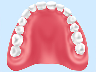 レジン床義歯