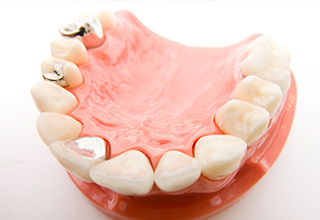 気になる銀歯を白いセラミックの歯に替えませんか？