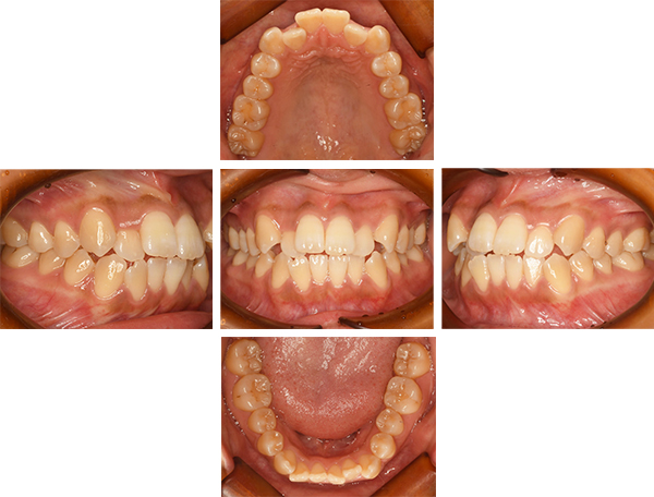 前歯の歯並びを改善した症例