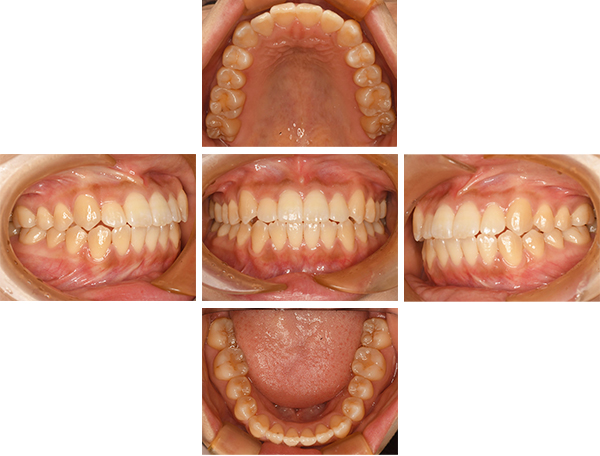前歯の歯並びを改善した症例