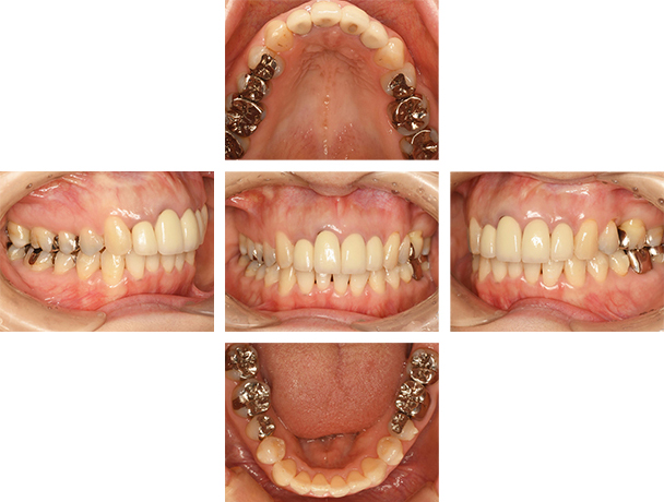 下の歯並びを改善した症例