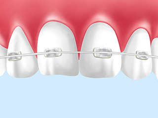 クリアブラケットとセラミックブラケット