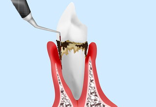 歯周病とは？