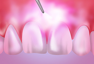 レーザーによる歯周病治療～ペリオウェイブ～