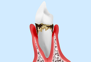 重度歯周炎