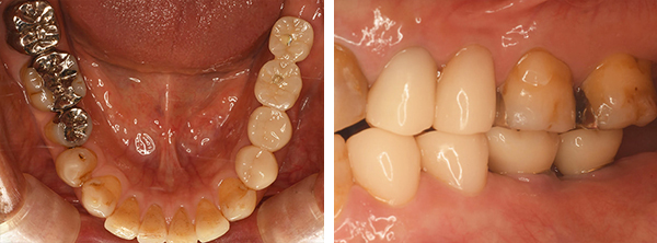 インプラントの症例写真